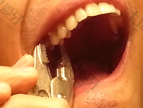 一次拔牙十颗，我的真实经历