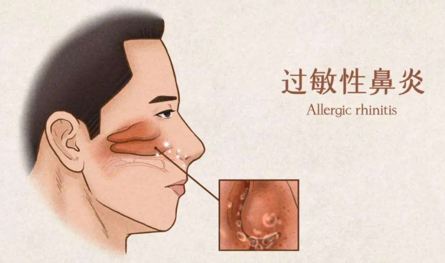 过敏性鼻炎的幕后黑手揭秘