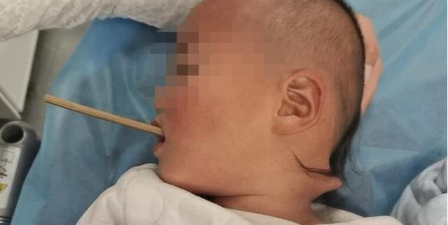 男童在幼儿园遭遇筷子插鼻穿孔事件，深度分析与反思