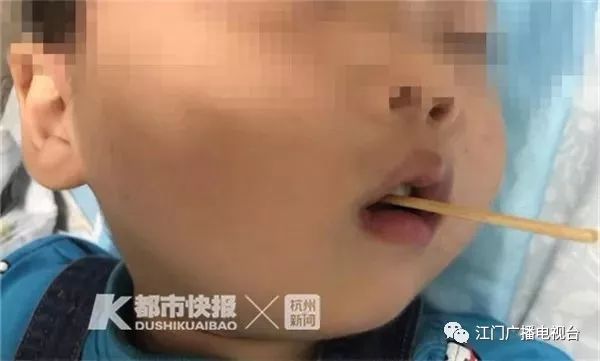 幼儿被筷子刺穿口腔后该怎么办？全面解析应急处理措施