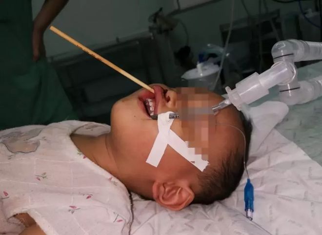 幼儿被筷子刺穿口腔后该怎么办？全面解析应急处理措施