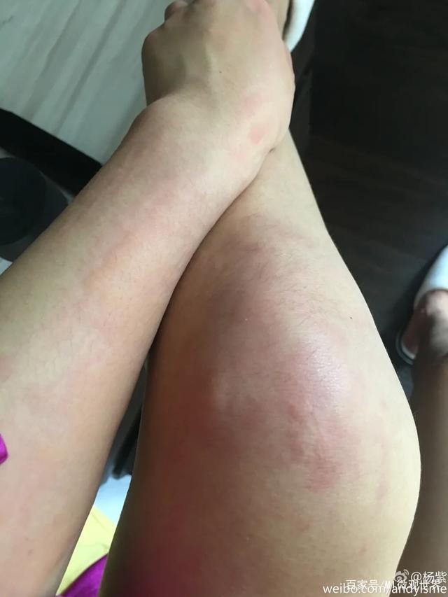 腿被烧烤签扎伤周围肿胀，正确处理与护理指南