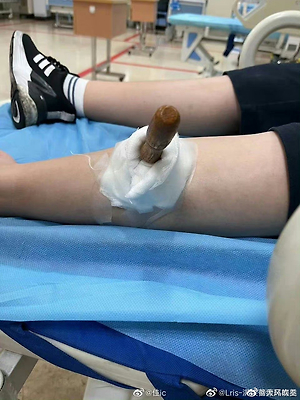 腿被烧烤签子扎了，怎么办？