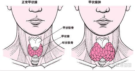 甲亢真的那么可怕吗？