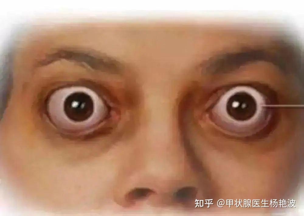 聊聊甲亢，深入了解甲状腺功能亢进
