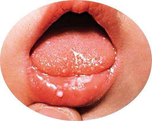 口腔溃疡会感染HPV病毒吗？解析口腔健康与HPV病毒的关系