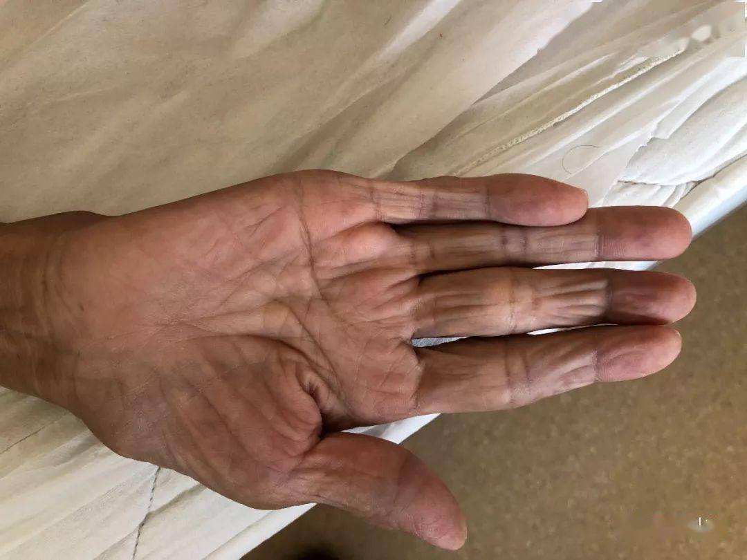 27岁男子长期攀岩致肌肉萎缩，运动与健康的双刃剑效应