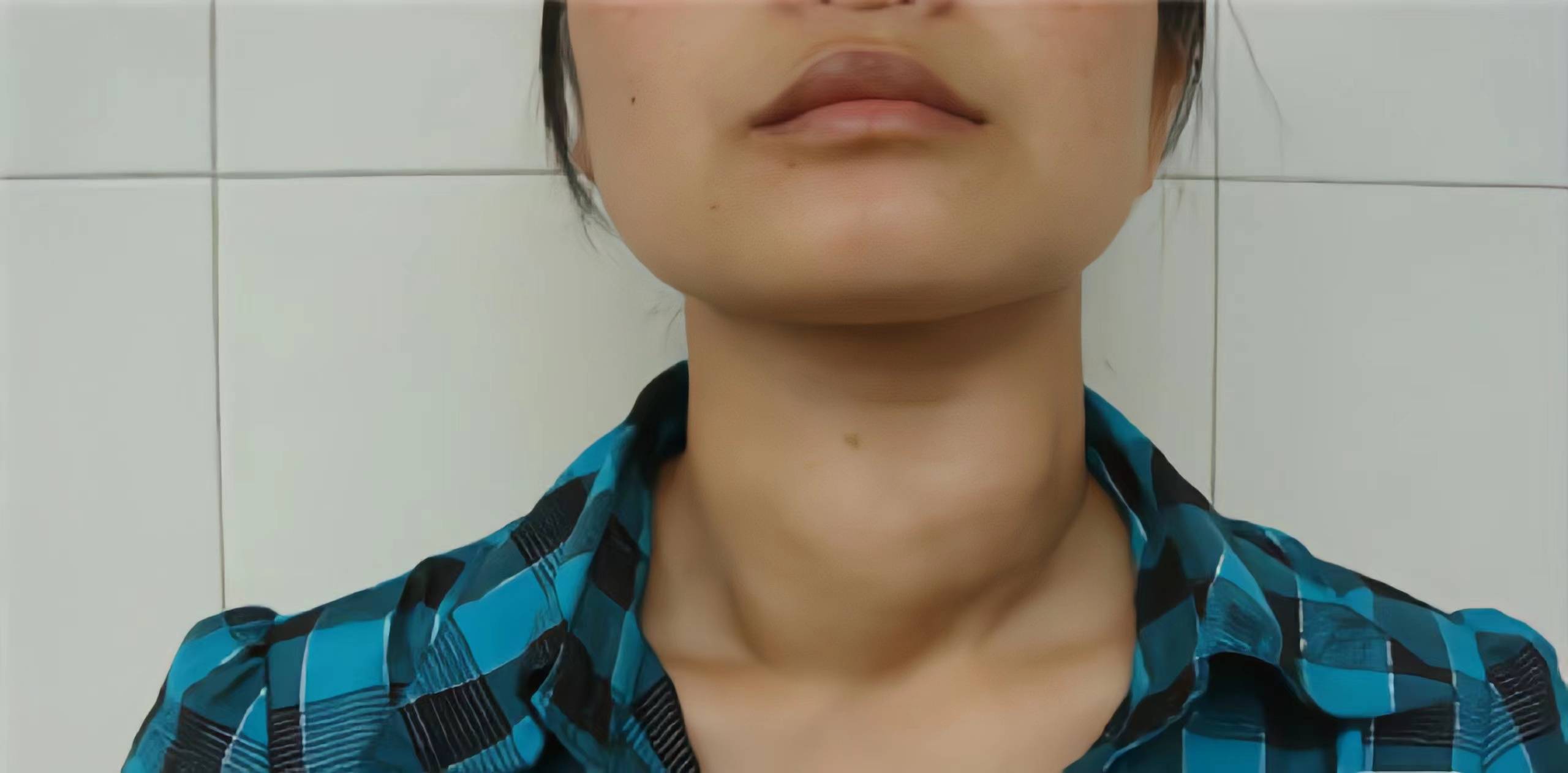 甲亢女孩难结婚？理解与支持是克服困境的关键