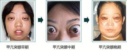 甲亢女孩能否找到好男朋友？