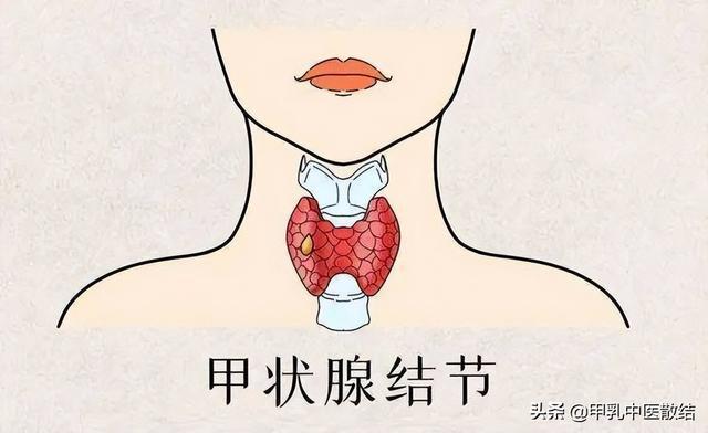 甲亢高发地区的人群分布与影响因素分析
