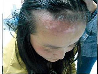 国内甲亢治疗，全面解析与深度洞察