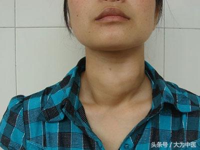得了甲亢去哪治疗好？全面解析治疗甲亢的最佳选择