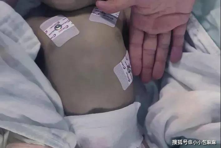 婴儿误食隔夜萝卜水泡奶中毒抢救全解析