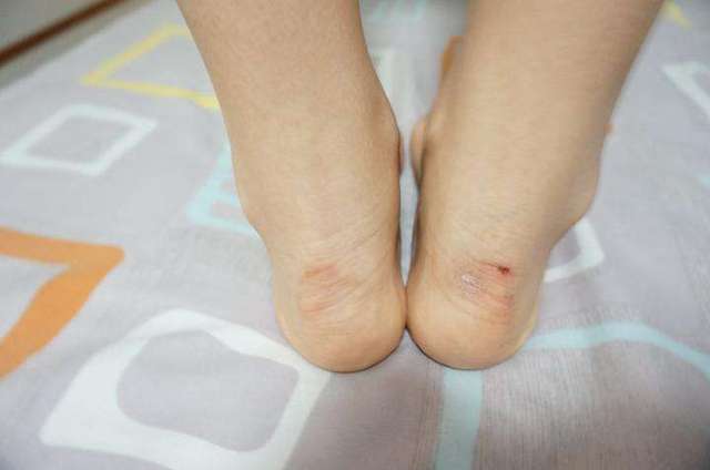 女鞋磨脚怎么办？终极解决方案指南