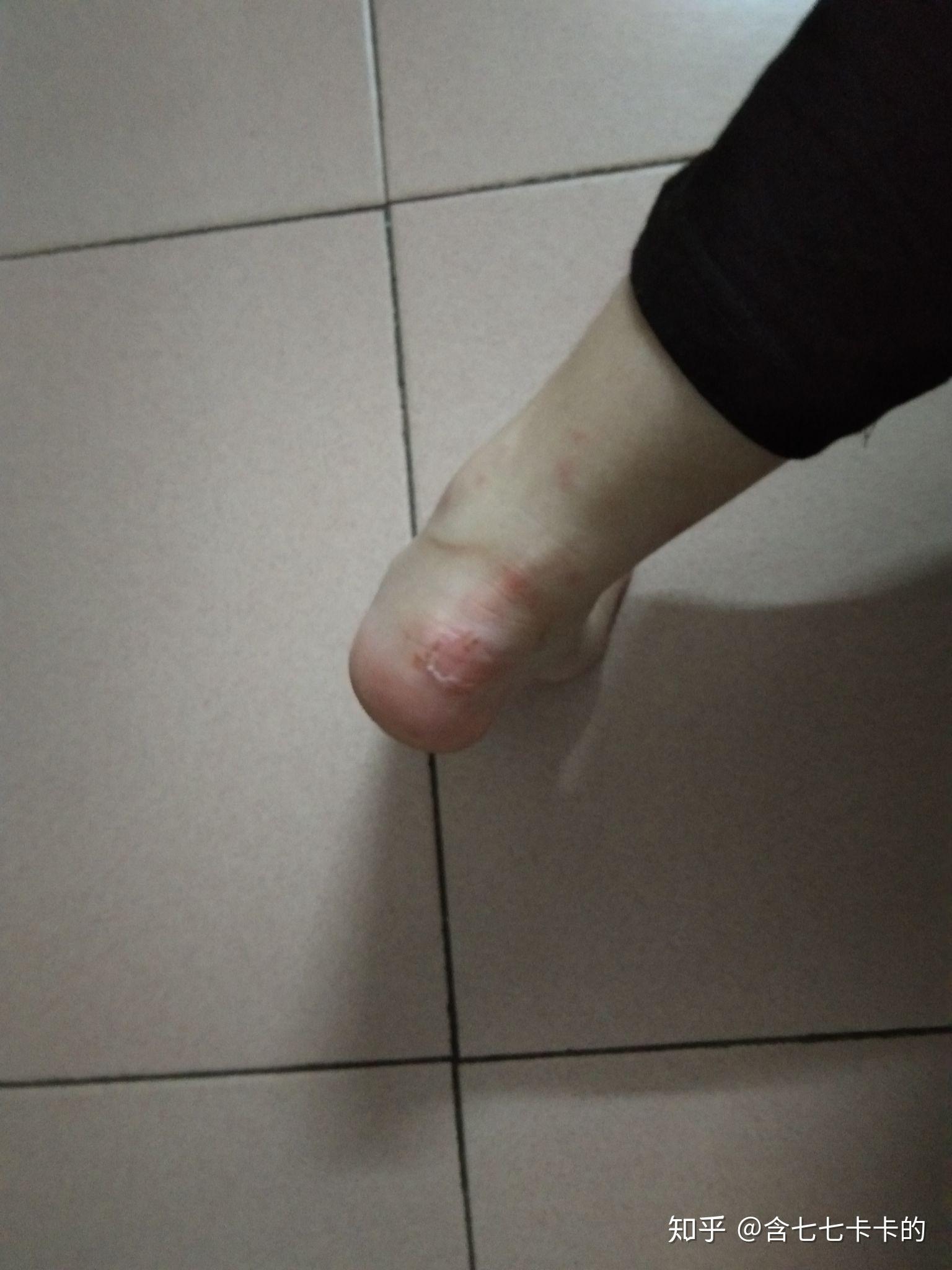女生鞋磨脚后跟怎么办？知乎上的实用建议