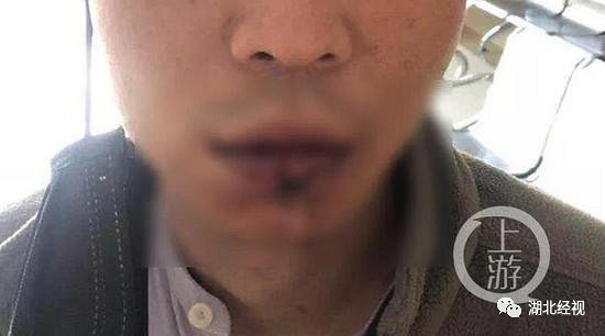 男子咬伤女主播嘴唇视频事件深度解析