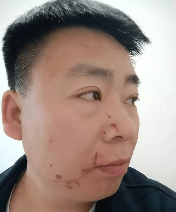 男粉丝咬伤女主播嘴，赔十万变赔十5？网络热点深度解析