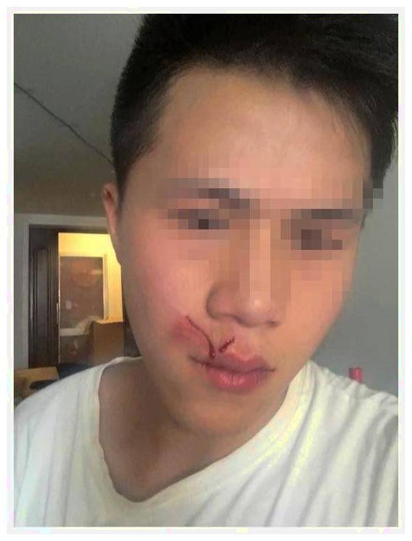男粉丝咬伤女主播嘴，赔十万变赔十5？网络热点深度解析