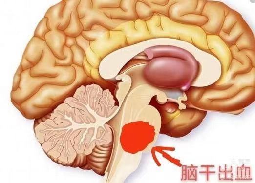 脑干出血死亡过程视频，深度解析与理解