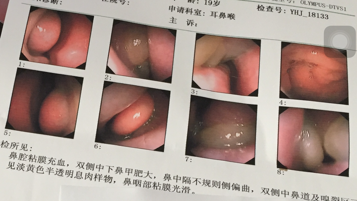 苟伟死因曝光，鼻息肉肥大致呼吸骤停