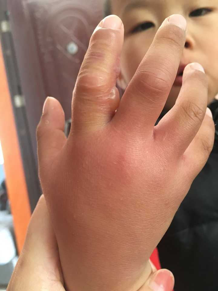 小孩被蜜蜂蛰了会自愈吗？全面解读与处理建议