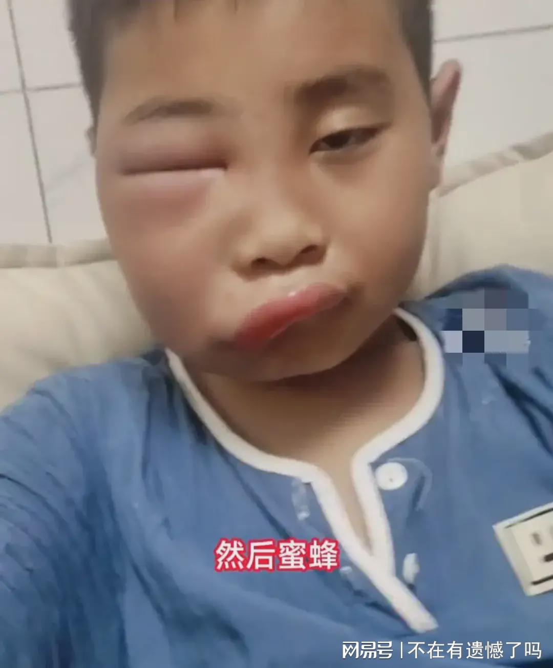 小孩被蜜蜂蛰了会自愈吗？全面解读与处理建议