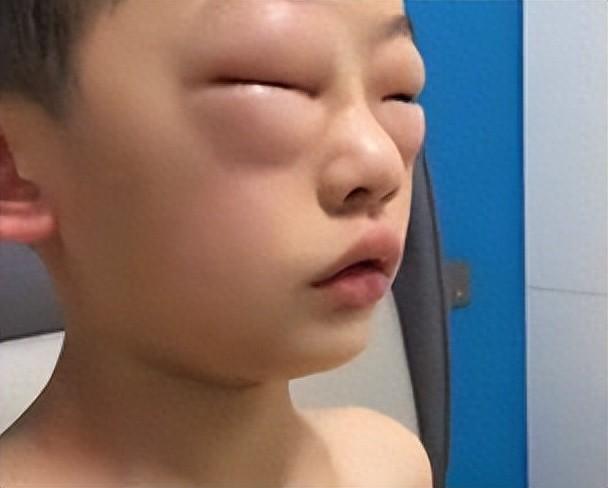 孩子一觉醒来脸肿成发面馒头，深度解析儿童突发水肿现象