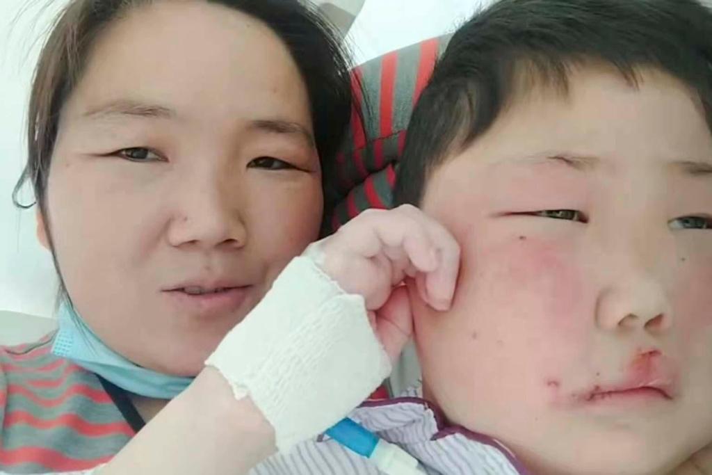 孩子一觉醒来脸肿成发面馒头，深度解析儿童突发水肿现象