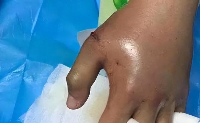被蛇咬两年后的后遗症，挣扎与希望
