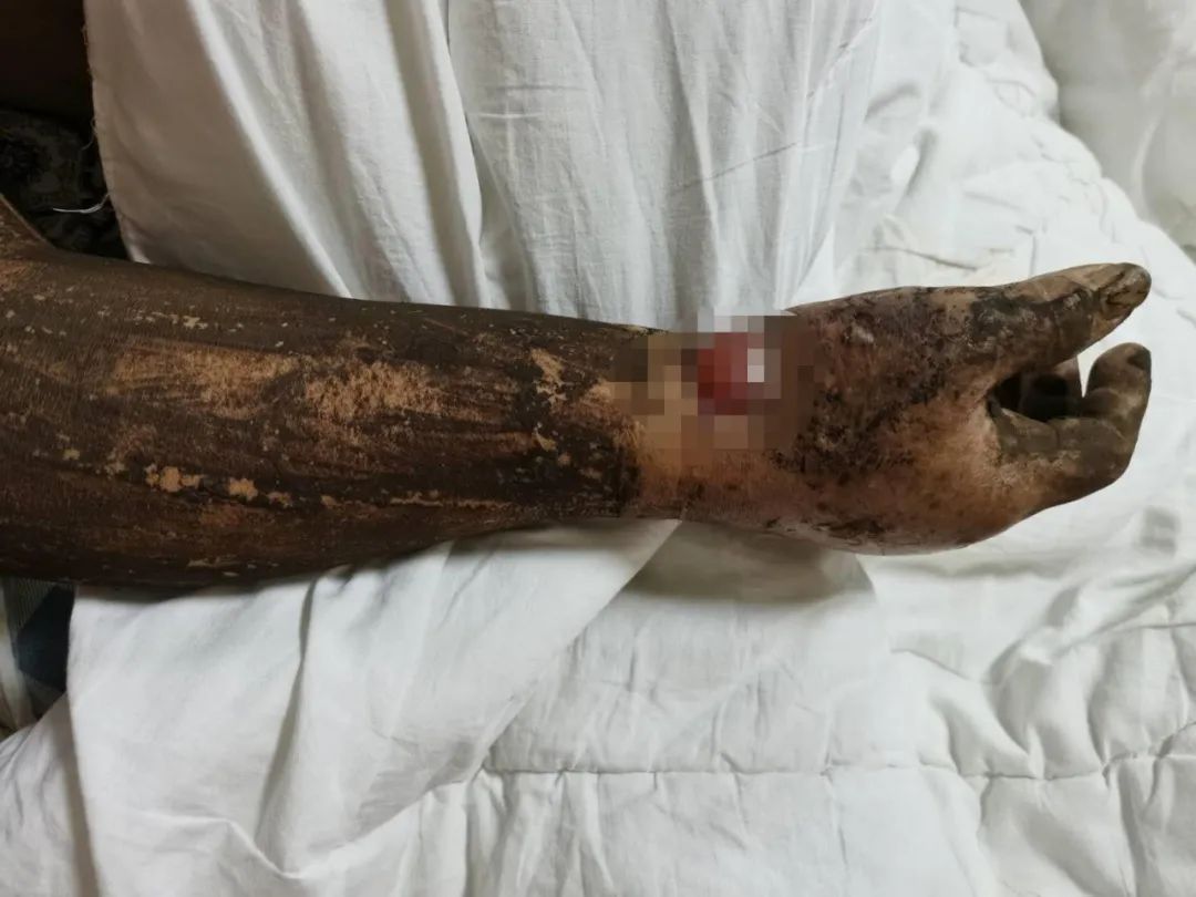 被蛇咬两年后的后遗症，挣扎与希望