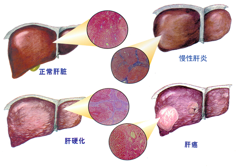 肝纤维化，一种疾病，其严重性如何？