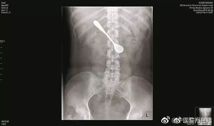 勺子不慎吞到肚子里怎么办？全面解析应对措施