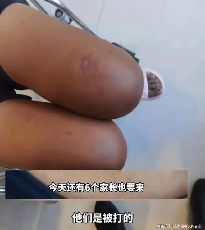 被教官体罚致换肾事件深度解析