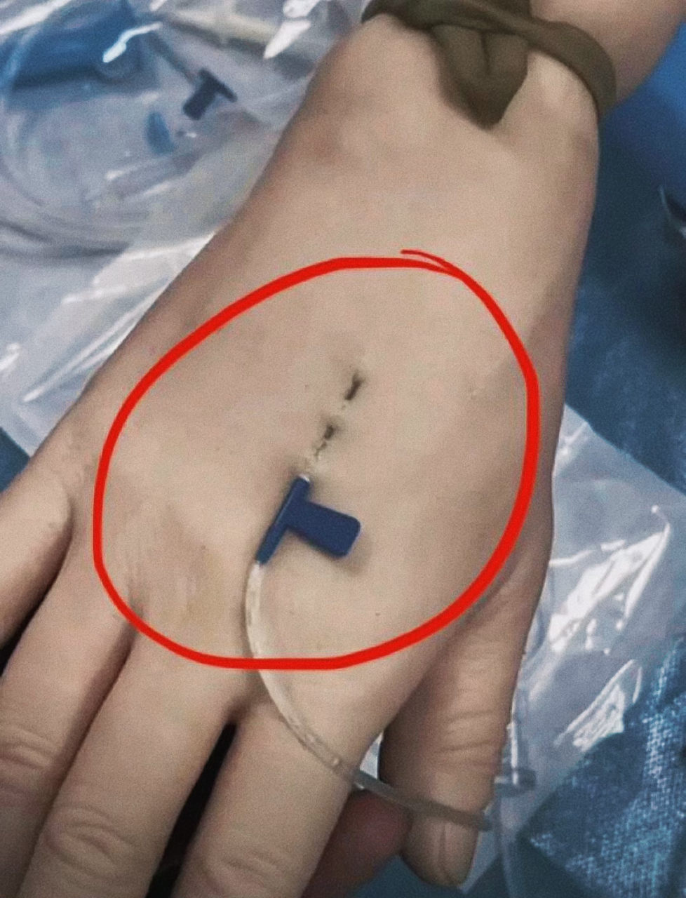 被注射器扎到会痛吗？揭秘注射过程中的真实感受