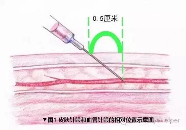 注射器扎人会流血吗？——关于注射器与人体关系的探讨
